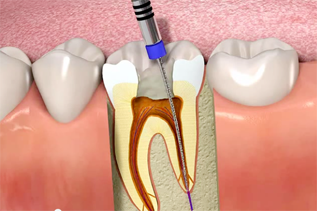 leczenie kanałowe endodoncja